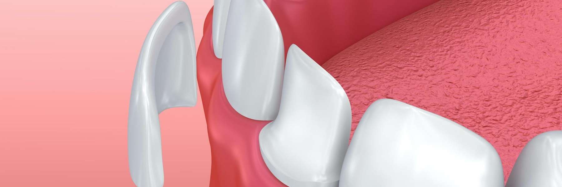 An illustration of dental veneers being placed on teeth