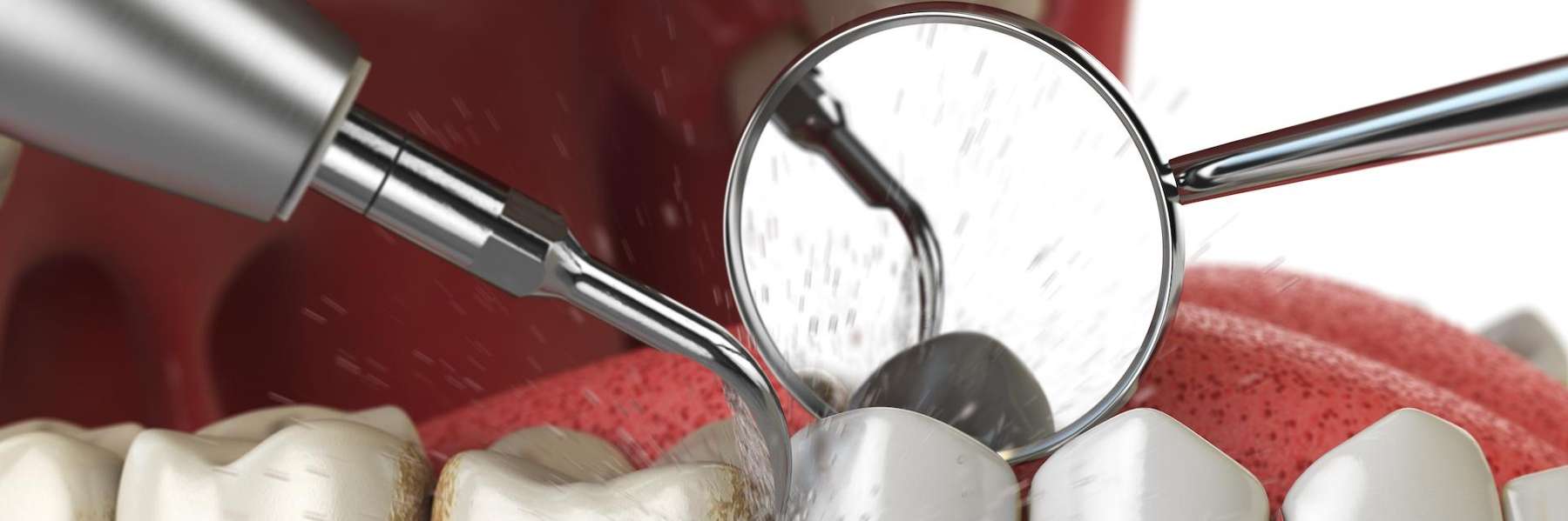 An illustration of a dental cleaning in greeley