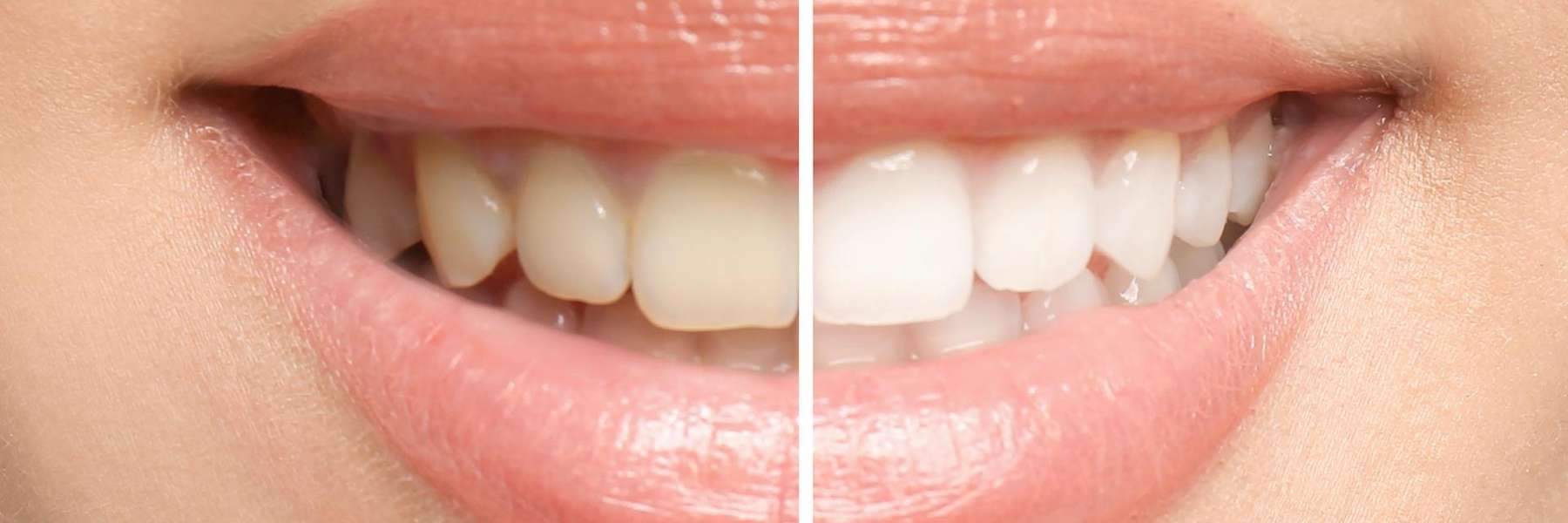 Visual representation of a woman's teeth pre- and post-whitening, emphasizing teeth whitening