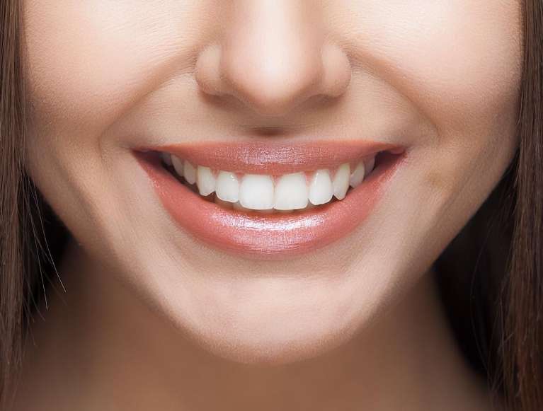 A smiling woman with whitened teeth