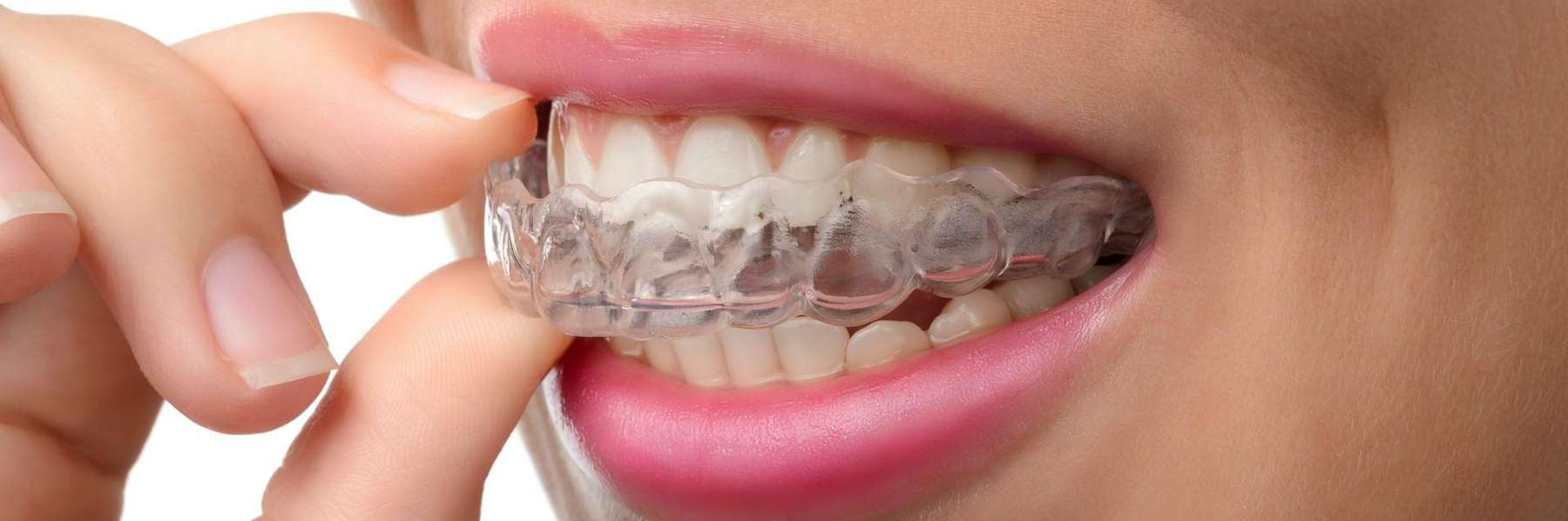 A woman taking out her Invisalign tray