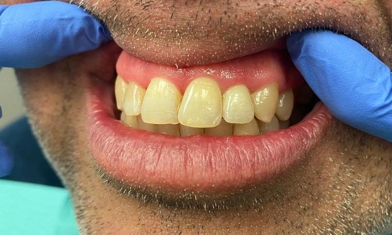 Dental-Crown-After-Image