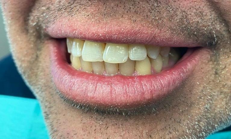 A dental patient before receiving a dental crown in Greeley