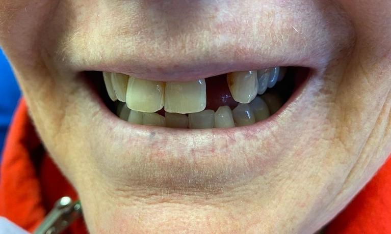 Dental-Bridge-Before-Image