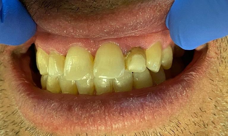 A dental patient before receiving a dental crown in Greeley